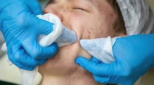 Fungal infections