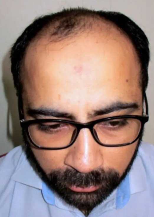 Before Hair Transplant