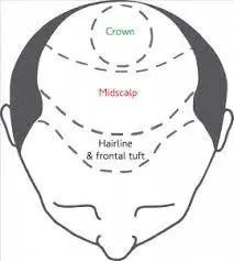 FUE Hair Transplant